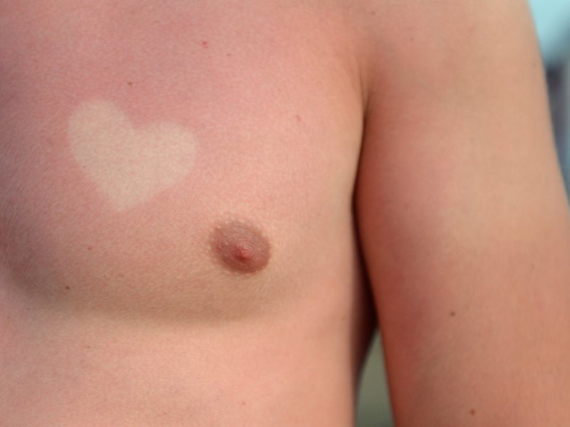 sunburnart.jpg