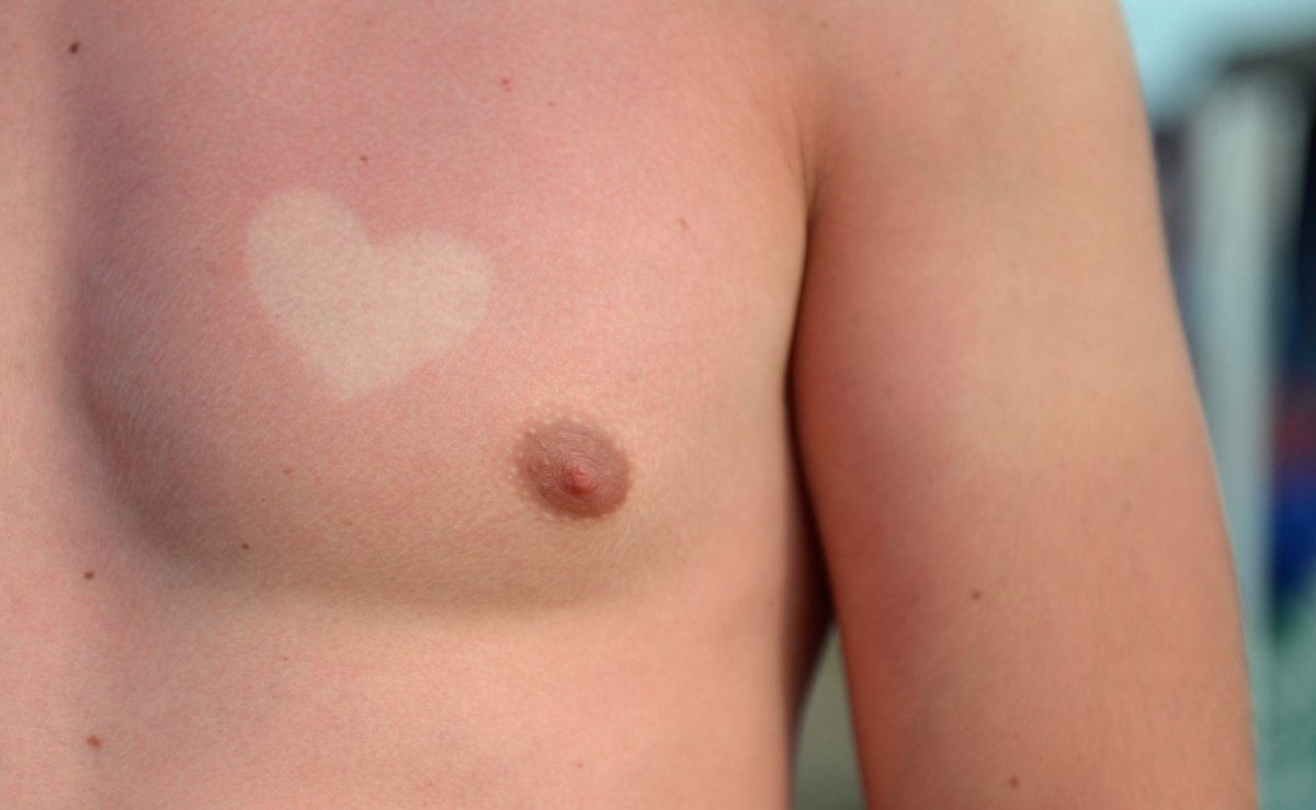 sunburnart.jpg