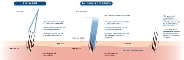 FUE und DHI Saphir im Vergleich. FUE und DHI Saphir im Vergleich.