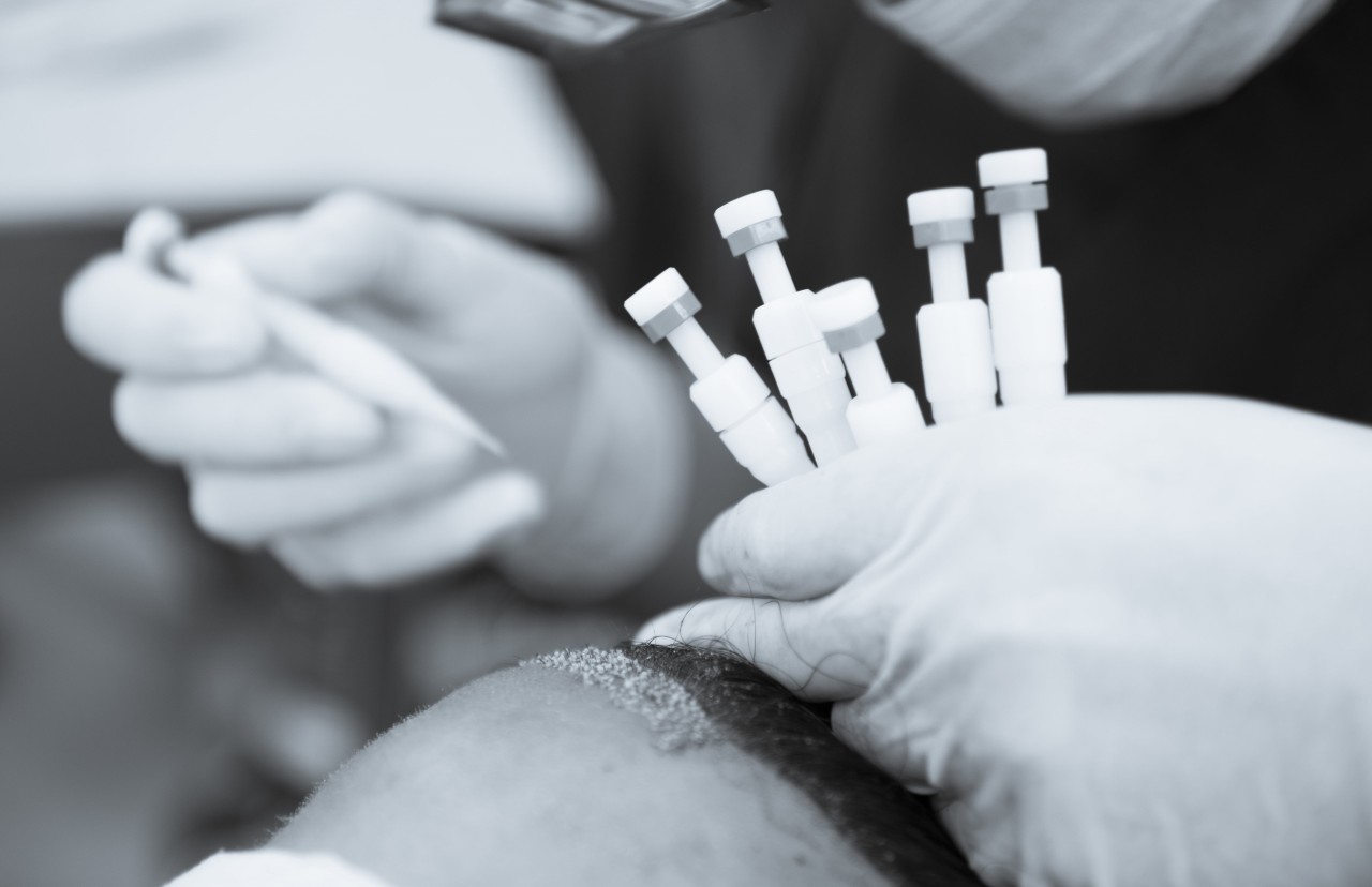 Mit der innovativen DHI Haartransplantation zum vollen Haar. Mit der innovativen DHI Haartransplantation zum vollen Haar.